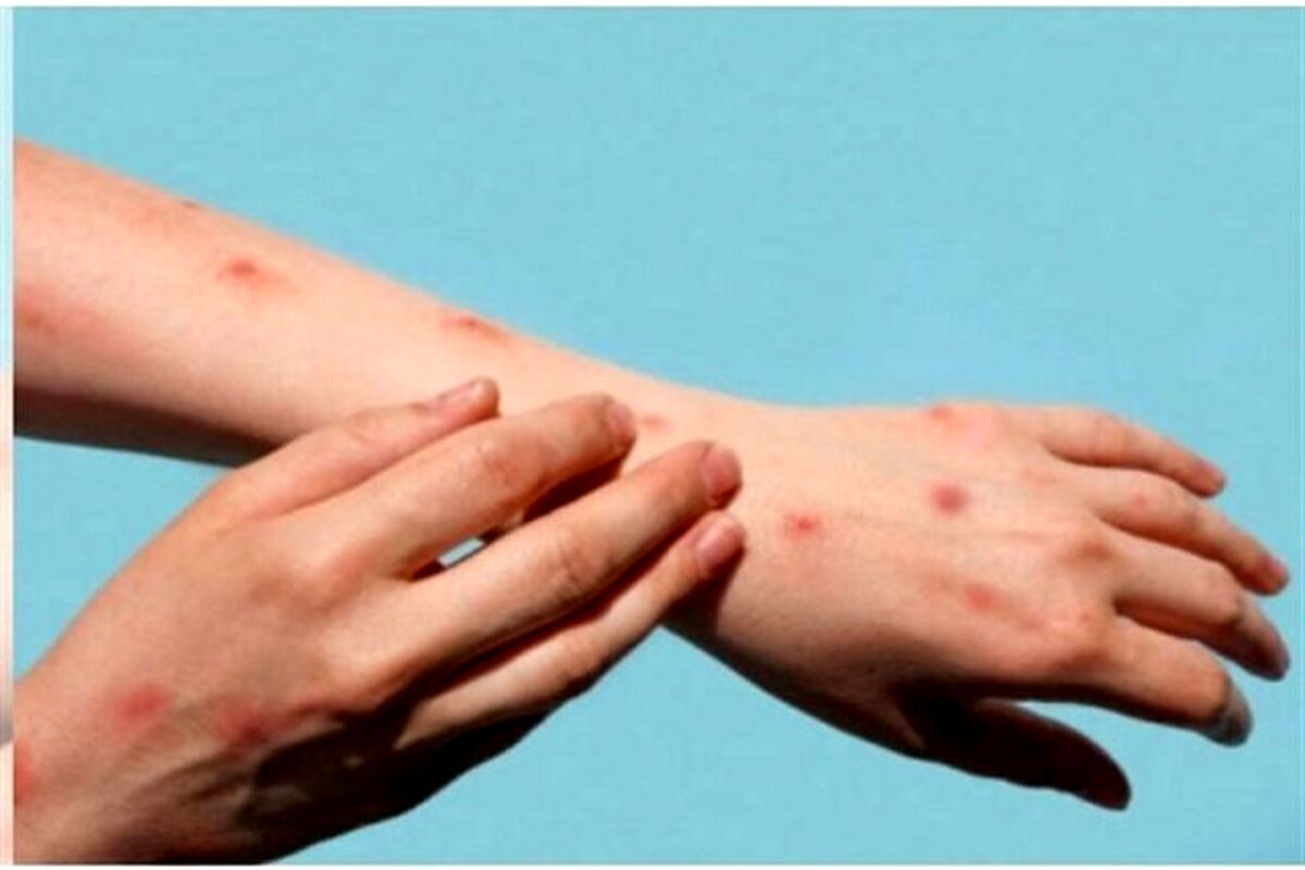 علائم و نحوه انتقال آبله میمونی