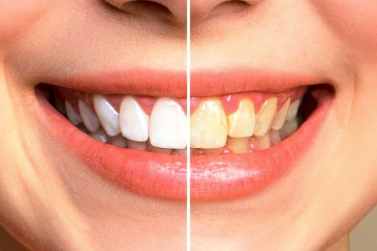 بهترین روش برای سفید کردن دندان با جوش شیرین | سفید کردن دندان در سه سوت