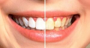 بهترین روش برای سفید کردن دندان با جوش شیرین | سفید کردن دندان در سه سوت