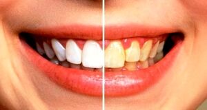 بهترین روش برای سفید کردن دندان با جوش شیرین | سفید کردن دندان در سه سوت