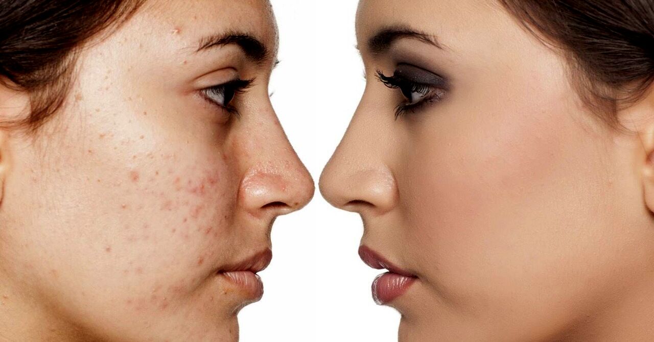 فیلم | از بین بردن جای جوش با چند راهکار عالی