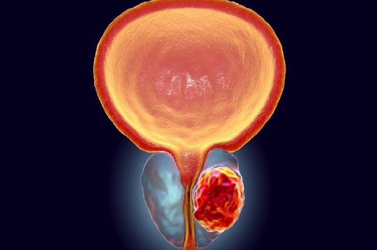 بهبود سرطان پروستات با این رژیم غذایی
