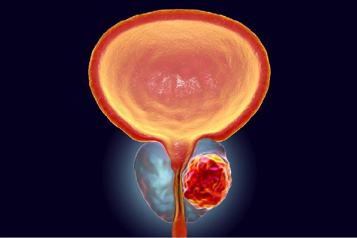 بهبود سرطان پروستات با این رژیم غذایی