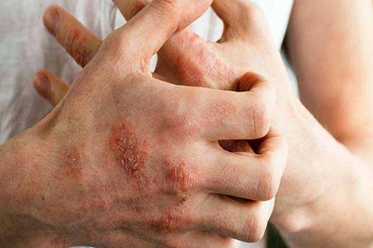 اگزما؛ بیماری فصل پاییز