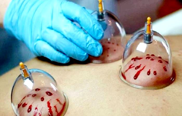 فواید انجام حجامت برای بیماریها و درمان | چه افرادی حجامت نکنند