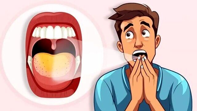 اینفوگرافیک | علت زردی زبان چیست؟