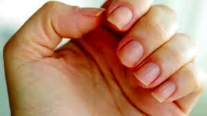 ایا قارچ ناخن دست خطرناک است؟ | درمان قارچ ناخن در منزل به سادگی