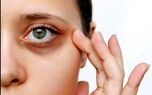 دلیل تیرگی دور چشم | این ویتامین مهم را کم دارید!
