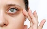 دلیل تیرگی دور چشم | این ویتامین مهم را کم دارید!