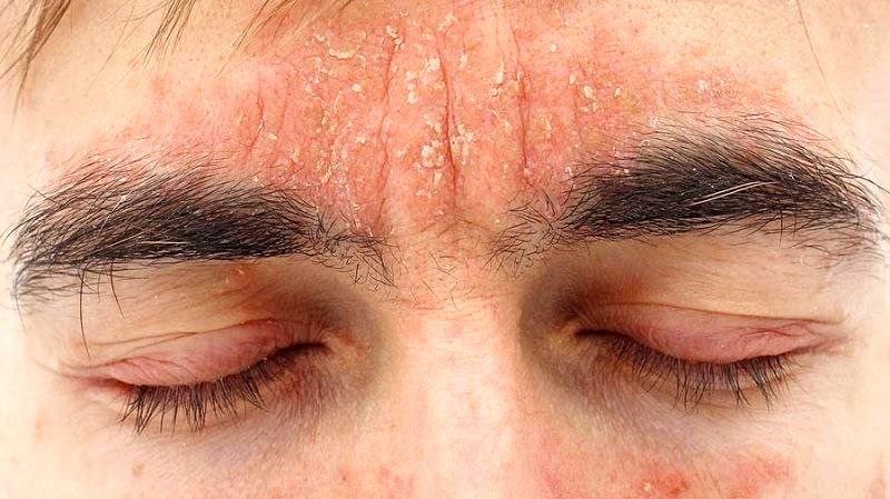 روش‌هایی ساده برای کاهش خشکی پوست