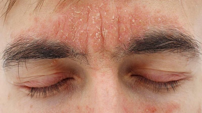 روش‌هایی ساده برای کاهش خشکی پوست