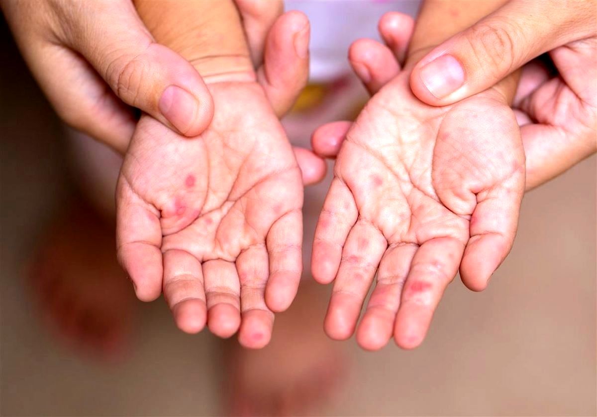 ویدئو | آخرین وضعیت تب برفکی در کشور