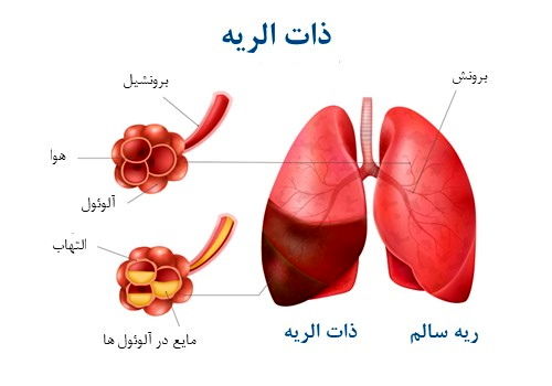 هشدار؛ ذات‌ الریه در نزدیکی شماست!