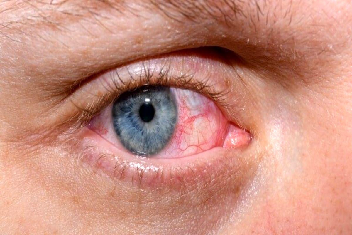 خشکی چشم چیست؟ | راههای درمان خشکی چشم