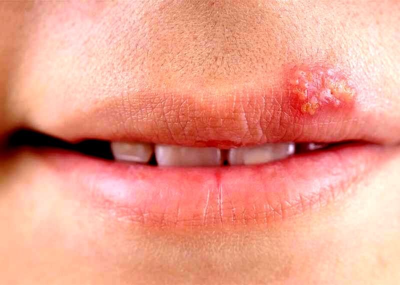 ترفندی ساده برای خلاص شدن از تبخال